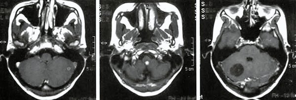 Feocromocitoma - Artículos - IntraMed