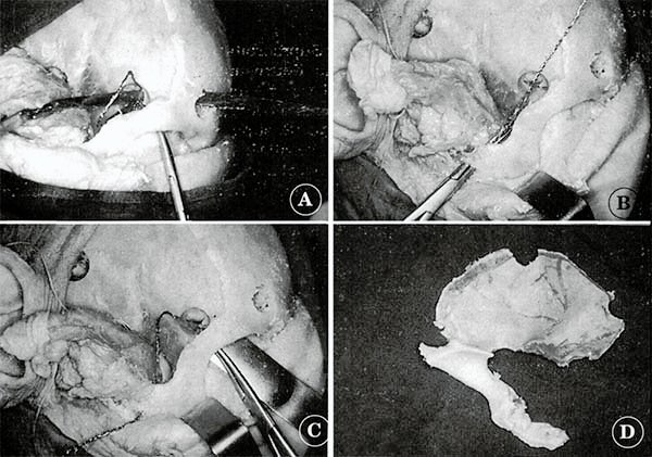 El Colgajo Orbitocigomatico Reflexion Anatomica Y Nota Tecnica Revista Argentina De Neurocirugia