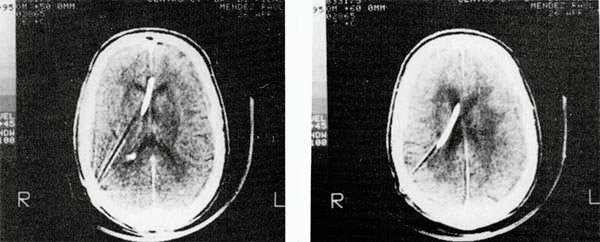 Hidrocefalia Normotensiva Idiopatica Resultado De Shunts De Lcr En 25 Pacientes · Revista 5365