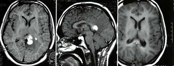 Feocromocitoma - Artículos - IntraMed