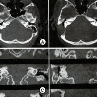 Fig. 5. Tomografia de cerebro con ventana ósea postoperatoria. A y B. Cortes axiales. C y D. Cortes coronales. Se observa defecto óseo post mastoidectomía, y una buena comunicación de la cavidad quística con el oído medio. Se observa también, aire en la cavidad quística residual.