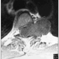 Fig. 1. Caso Nº 5 con neurofibroma dorsal y trastorno funcional severo (Frankel A; VAS 7/10; Karnofsky 30%) extendido en varias capas y zonas radiadas.