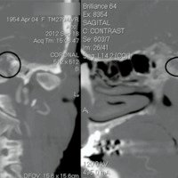Figura 3: Angio tomografía Cráneo-cervical: Muestra el carácter lítico de la lesión que compromete parte lateral del clivus y ápex petroso (la sutura petro-clival). Permite un análisis detallado entre la arteria carótida interna y el tumor. 