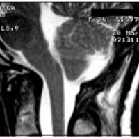 Fig. 3. IRM sagital de cerebro ponderada en T2 que muestra la creación de una neocisterna luego de la descompresión cráneo espinal.