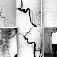 Fig. 2. Paciente. de 27 años con An. Co. Post. izquierdo (A). Embolización con coils y disección de ACI izquierda progresiva (B,C). Colocación de Stent (D,E).