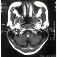 Fig. 3. 1RM axial enT1 más gadolinio que muestra dos nódulos cereberlosos, uno de ellos quístico, y un tercer nódulo en el óbex.