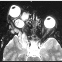 Fig. 4. IRM en T2. Corte axial donde se observan neurofibromas intra y extraorbitarios.