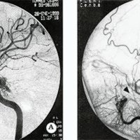 Fig 2. Angiografía Digital de FCC postraumática de escaso flujo sin "robo" hemodinámico. 