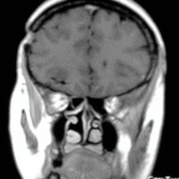 Figura 7: RM de encéfalo c/ gadolinio control post-quirúrgica, corte coronal. 