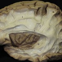 Figura 14: Cara lateral del hemisferio cerebral izquierdo (después de la remoción de la substancia gris y de las fibras en “U”). 1) Fascículo longitudinal; 2) Cápsula interna; 3) Fascículo arqueado; 4) Surco circular de la ínsula (parte superior); 5) Giro corto de la ínsula; 6) Estrato sagital.