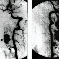 Fig. 3. Angiografía vertebral izquierda en incidencia frente (A) y perfil izquierdo (B), donde se identifican idénticas estructuras a las señaladas en Fig. 2.