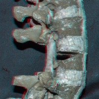 Figura 6: Vista lateral derecha. Osteotomía de Grado 3. Resección en cuña del cuerpo vertebral de L3, junto con los pedículos y arco posterior. El complejo articular L2-3 y L3-4 también fue resecado.