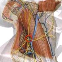Figura 2: Punto de entrada para el bloqueo superficial, por el borde posterior del músculo ECM.