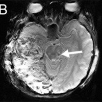 Resonancia cerebral simple después de una craniectomía descompresiva por trauma craneoencefálico severo. A) Se observan múltiples cambios isquémicos en la seciencia de difusión. nivel del lóbulo temporal derecho. en los ganglios basales derechos, con hernia trans-craneal por el defecto de la craniectomía. También hay imágenes hipointensas en el mesencéfalo. en el tálamo anterior derecho en la secuencia de susceptibilidad magnética. B, C), que demuestra lesión axonal difusa grado III.