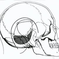 Fig. 3. Esquema de las incisiones posibles y proyección de la craneotomía.