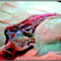 Fig. 2. Preparado anatómico donde se evidencia a la arteria coroidea posteromedial (ACPM) acompañada de la vena cerebral interna (VCI) en relación con el techo del III ventrículo, transcurriendo por el receso suprapineal (RSP), situado inmediatamente superior a la glándula pineal (Pi).