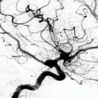 Fig. 2. Angiografia digital de la arteria carótida interna derecha en proyección lateral. Se observa un aneurisma pequeño de cuello grande.
