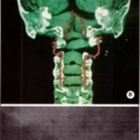 Fig. 3. A. Angio TAC: defecto del atlas donde se obtuvo la biopsia. B: Dislocación atlantoaxoidea. C: Rx posoperatoria de fijación occípitocervical.