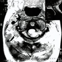 Fig. 4. IRM. Corte axial en T1 pasando por C2 donde se visualiza lesión isointensa intraespinal extramedular que comprime y desplaza ventralmente a la médula cervical.
