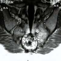 Fig. 4. IRM postoperatoria que muestra lafalta del quiste y la presencia del tejido adiposo dejado en su lugar.