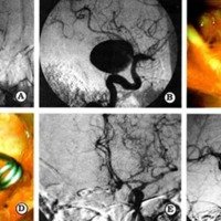 Análisis y Resultados en 100 Pacientes Operados de Aneurismas Cerebrales con Gradación Hunt - Hess 1, 2 y 3