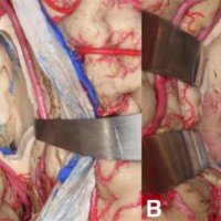 Figura 8: A) Identificamos a la ven tálamoestriada, vena septal anterior, foramen de Monro y plexo coroideo. B) A través de una vía transfornical podemos acceder al III ventrículo.