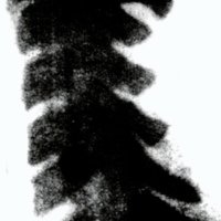 Fig. 3.Vista lateral de proyectil en columna cervical obtenida por H. Cushing en noviembre de 1896,
