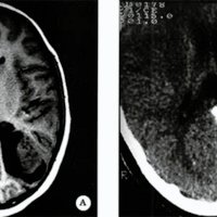 Fig. 2. Caso 2. A. IRM prequirúrgica en T1 sin contraste. B. TAC posiquirúrgico con contraste.