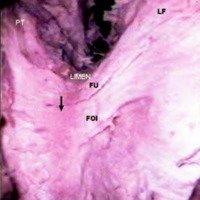 Fig. 6. Vista de los fascículos unciforme y frontooccipital inferior desde arriba, para apreciar la inflexión de las fibras al penetrar en el tallo temporal (flecha).