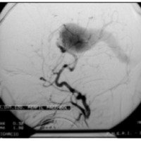Fig. 3. Angiografía cerebral de la arteria carótida izquierda (perfil), que evidencia una MAG tipo coroide
