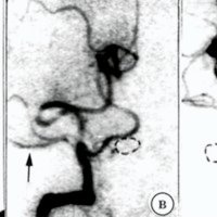 Fig. 3. Caso 2. A) Angiografia AV derecha incidencia anteroposterior que muestra aneurisma y disección (flechas negras) distales al origen de la ACPI (flecha) B) Angiografia AV derecha postoclusión (balón en línea de puntos) que muestra relleno de la ACPI (flecha) desde la misma AV; C) Angiografia AV izquierda que muestra correcta suficiencia en el llenado del tronco basilar (el balón oclusivo en el aneurisma disecante se encuentra marcado en línea de puntos).