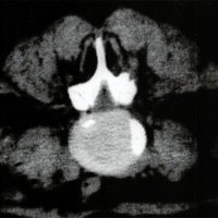 Fig. 2. Paciente GS. Tomografia computada. Estrechez del canal raquídeo.