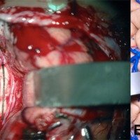 Figura 7: A) Callostomía longitudinal de no más de 25 mm. Puede realizarse entre ambas arterias pericallosas o en el caso de que estas se encuentren muy próximas se puede efectuar lateral a las mismas. B) Marcación de la callostomía en espécimen cadavérico.