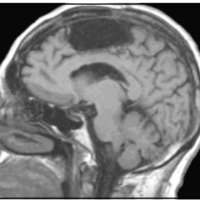 Fig. 3. IRM corte sagital postoperatorio mostrando cavidad quirúrgica