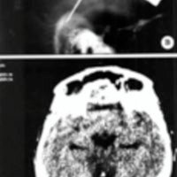 Fig. 1. Paciente de 12 años de edad, con astrocitoma fibrilar grado II, de tronco cerebral. A. IRM, corte sagital. B. Rx. de cráneo, de perfil con marco estereotáctico y la cánula de biopsia. C.TAC de control postoperatoria con esfera de titanio en el centro del tumor donde se efectuó la biopsia. D. Foto del paciente.