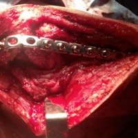 Artrodesis de Hombro vs. Cirugía Primaria de Reconstrucción en Pacientes con Lesiones Graves de Plexo Braquial: Estudio Comparativo 