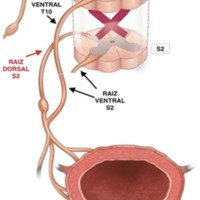 Figura 5: Anastomosis en pacientes lesionados medulares entre raíz ventral D10 y raíz ventral S2.