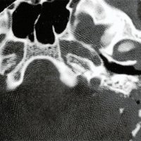 Fig. 3: Solución de continuidad en apófisis mastoides, fragmento óseo en el conducto auditivo y fractura de su pared posterior. Celdas mastoideas ocupadas.
