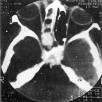 Figura 1.(Caso N° 1). La tomografía muestra una formación de 1,55 cm de diámetro, con erosión del etmoides y esfenoides.