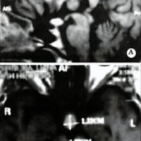Fig. 1. 1997, IRM con una pequeña lesión de 1,23 x 1,17 cm comprometiendo la neurohipóftsís y el infundíbulo.