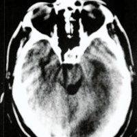 Fig, 1. TAC de craneo. Imagen hipodensa en lamina cuadrigeminal.
