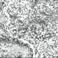 Fig. 1. Tumor medular: astrocitorna anaplásico. Células pleomórficas dispuestas en empalizada rodeando focos de necrosis.