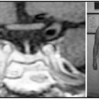 Fig. 3 A. IRM, ausencia de la luz de la carótida interna derecha e hiposeñal en T2 en la región derecha de la glándula. B. Paciente en junio de 2007 con recuperación clínica y hormonal de enfermedad de Cushing.