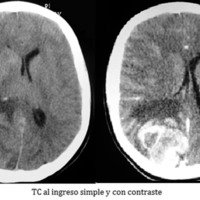 Hemangiopericitoma cerebral en paciente adolescente: reporte de un caso y revisión de literatura