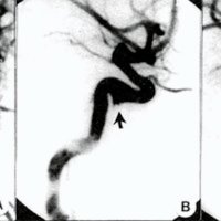 Fig. 3. Caso Nº 3: A) Angiografía carotídea derecha en incidencia lateral, muestra opacificación del seno cavernoso (flecha recta) y drenaje precoz de la vena basal de Rosenthal (flecha curva); B) oclusión del tronco ínferolateral con coils (imagen sustraída) (flecha) con desaparición de la fistula carótido cavernosa; C) control angiográfico a 4 meses muestra remodelamiento de la arteria (flecha) y desaparición definitiva de la fístula