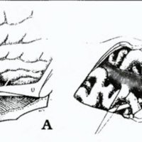 Fig. 10: Esquema en vista lateral del abordaje al seno cavernoso según Parkinson.