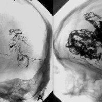 Figura 2: A) Imagen de angiografía sin sustracción ósea proyección oblicua izquierda de MAV occipital izquierda, tratada en el año 2009 con Onyx con catéter no desprendible. B) Imagen de angiografía sin sustracción ósea proyección lateral izquierda de MAV frontal izquierda, tratada en el año 2013 con Onyx con catéter desprendible, obsérvese mayor cantidad de agente embolizante en el interior del nido y mayor densidad.