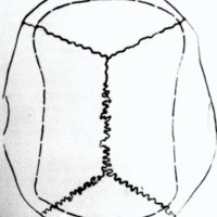 Figura 2. Esquema de la craneotomía total del vertex. publicada por Epstein. usada en nuestra serie.