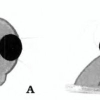 Fig. 1. A. Técnica de embolización selectiva de aneurisma fusiforme por atrapamiento. B. Embolización con balón preservando el flujo carotídeo,<br />
