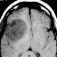 Congruencia T1-T2 en la IRM como Indicador de la Posibilidad de Reseccion Macroscopica Total del Glioma Cerebral